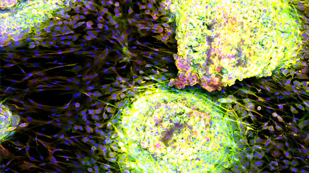 Engineered 3D lung tumor microenvironment