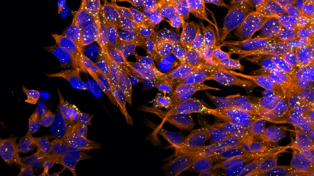 Individual RNA transcripts for POLR2A (yellow) and PPIB (light blue) expressed by 22Rv1 prostate cancer cells can be visualized as single spots using RNA in situ hybridization. Microtubules are displayed in orange. 