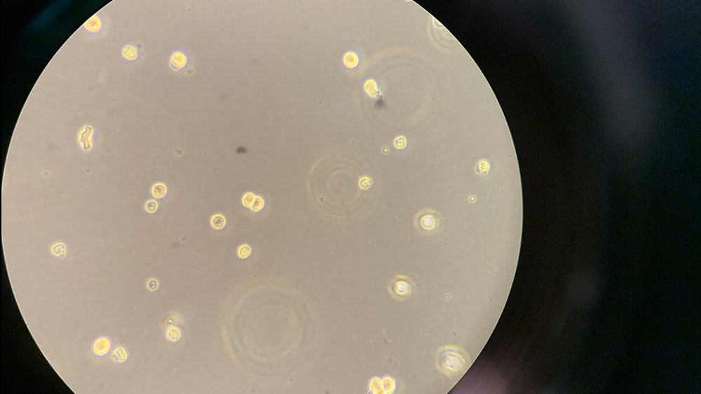 This photo visualizes leukemia cells in suspension, but uniquely all on the same plane. It is generally hard to see the cells this was as they are suspended, and some appear closer/farther away, making magnification choice difficult. It is also worth noting that prior to my own experimentation, I was unable to find any reference photos of AML-193 in culture online at all.
