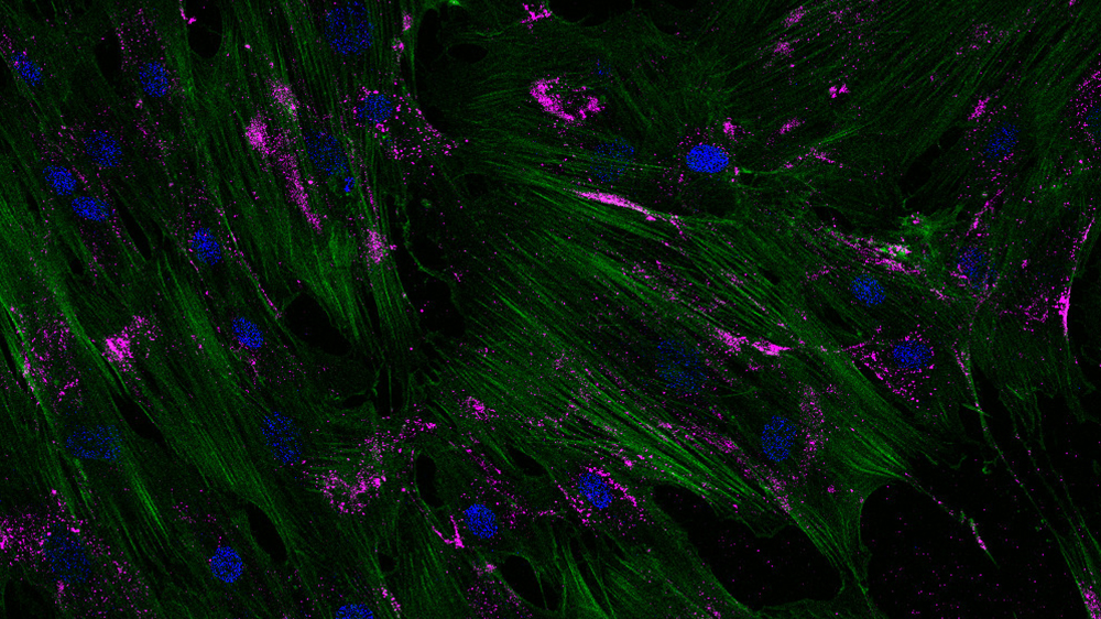 Human MSCs (ATCC PCS-500-012) Loaded with PBAE nanoparticles.