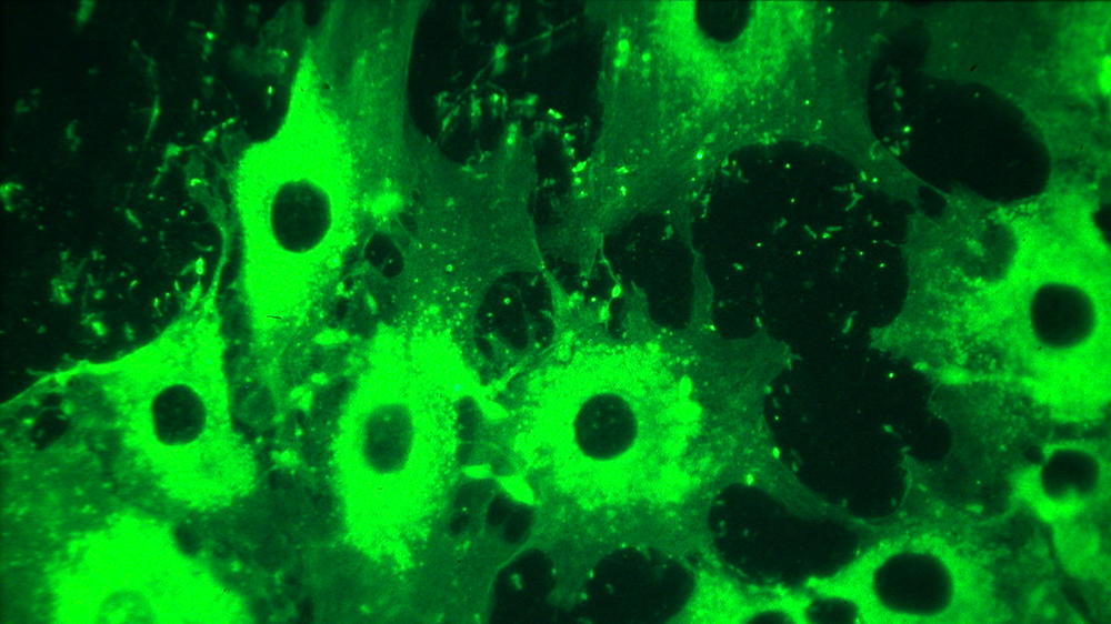 Example of with the immunologic The abnormality of RPE (ATCC CRL-2302) hypersensitivity revealing patient's serum antibody activity on cultured human RPE cells, visualized by indirect immunofluoresence. Antibody activity is confined primarily to the cytoplasm, to the exclusion of the nuclei.