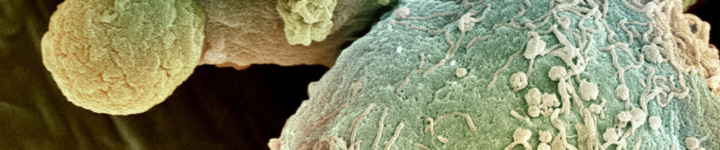 Lymphoma cancer cells, green and brown.
