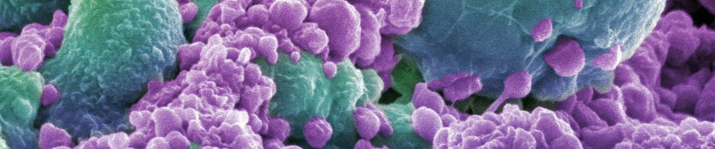 Green and purple breast cancer cells.
