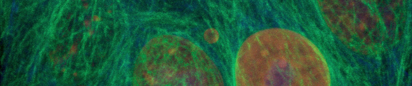 Breast cancer cells.