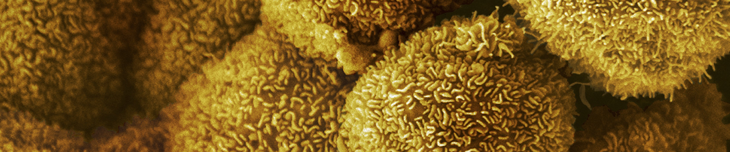 Yellow pancreatic cancer cells.