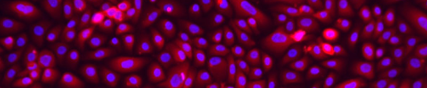 Pink and blue lung epithelial cystic fibrosis cells.