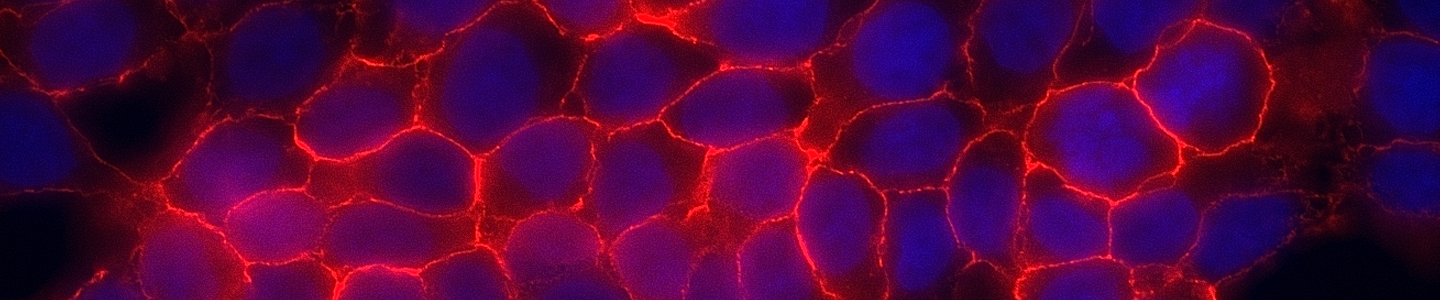 Blue and red prostate adenocarcinoma.