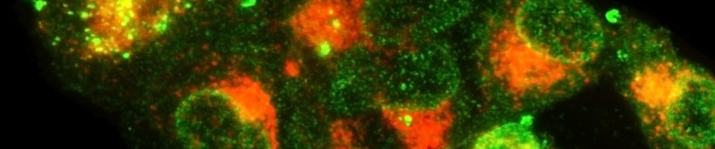 Fluorescent orange and lime green spheres of white blood cells stained with monoclonal andibodies.