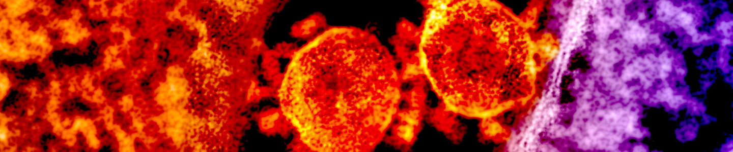 Grainy, red-orange and purple spheres of Middle East respiratory syndrome coronavirus.