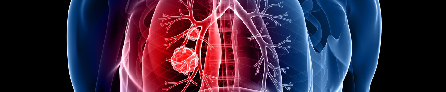 Transparent illustration of red and blue lungs with a red growth in a human torso.