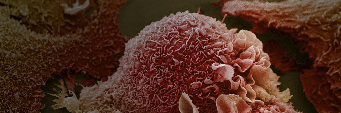 Pink and orange lung cancer cells.