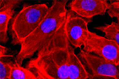 Fluorescent red and purple colon cancer epithelial cells.