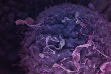 Purple breast cancer cells.