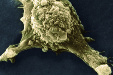 Metastasis melanoma cell with protrusion.