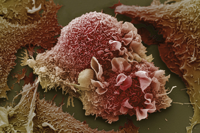 Pink and orange lung cancer cells.