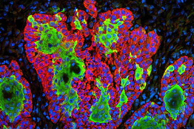 Skin squamous cell carcinoma cells.