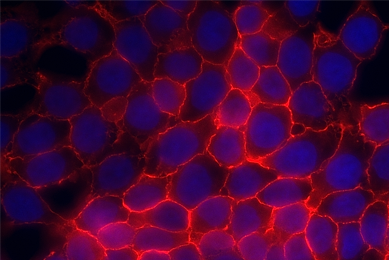 Blue and red prostate adenocarcinoma.