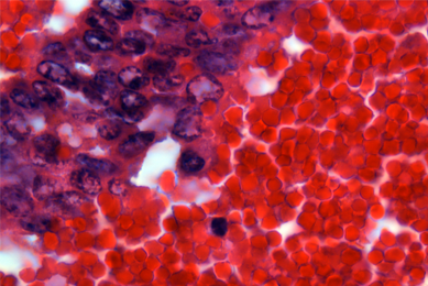 Red and purple tumor metastasis.