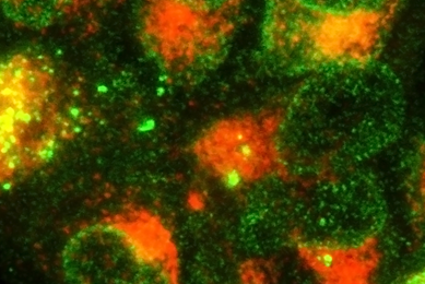 Fluorescent orange and lime green spheres of white blood cells stained with monoclonal andibodies.