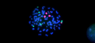 Non-hodgkin lymphoblast mantle cell.