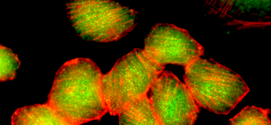 Fluorescent red and yellow-green adenocarciona mammary gland cells.