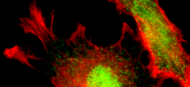Fluorescent red and yellow-green non-small cell lung cancer cells.