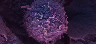 Purple breast cancer cells.