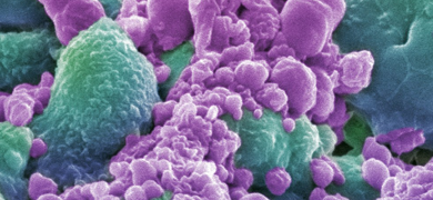 Green and purple breast cancer cells.