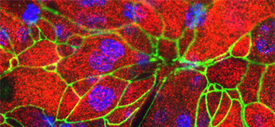 NCI-H441-human-papillary-adenocarcinoma-red Red and green human papillary adenocarcinoma cells.