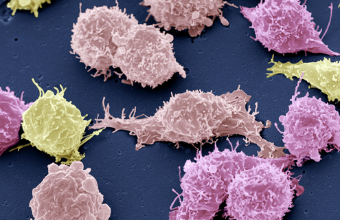 Pink and yellow cancer cells.