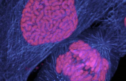 Human breast cancer cell dividing.