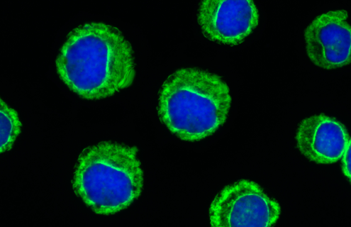 Fluorescent blue and green spheres of leukemic cells.