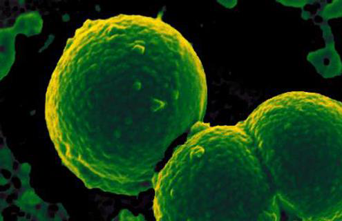 Cluster of round, green, textured, neutrophil-ingesting  Methicillin-resistant Staphylococcus aureus.