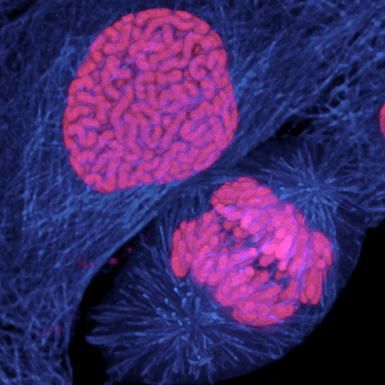 human-breast-cancer-cell-dividing Human breast cancer cell dividing.