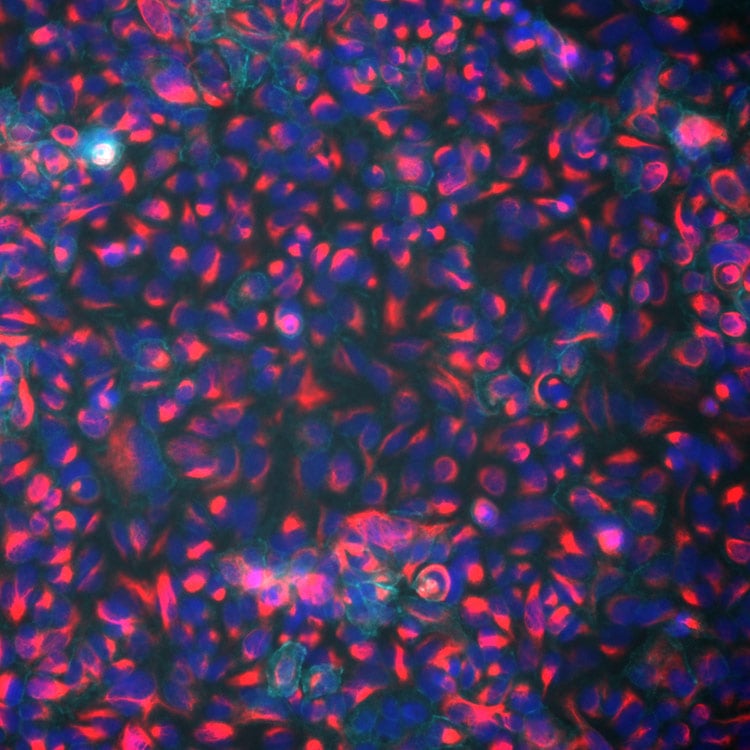 lung-emt-VimRFP-activated2 cells, EMT-MET, Lung EMT, VimRFP, pink, blue, mesenchymal, epithelial, transition,