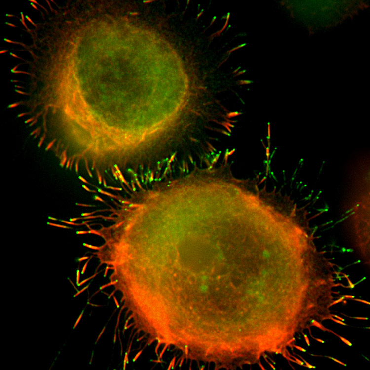K-562-ATCC-CCL-243-bone-marrow-leukemia Orange and green K-562 bone marrow cells.