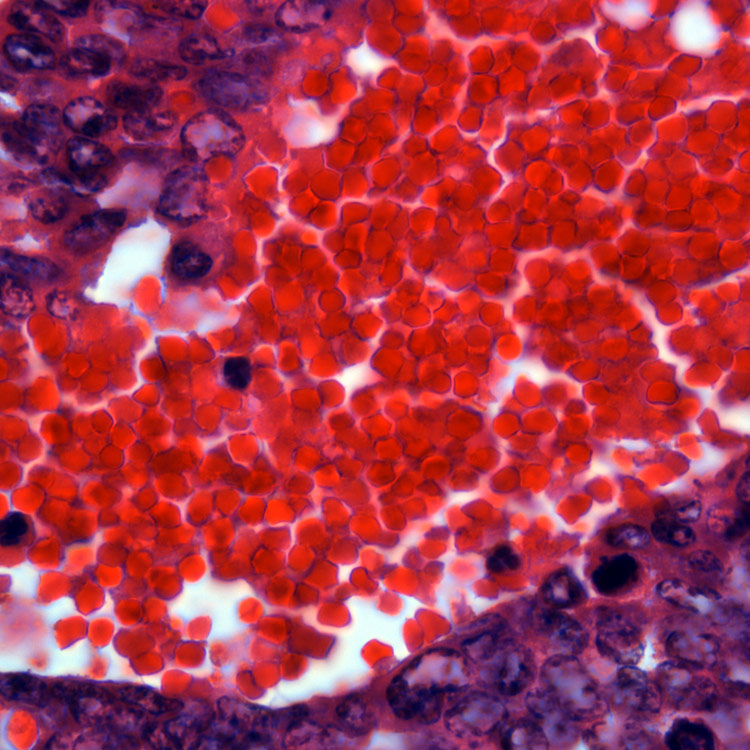 tumor-metastasis-I-10-Leydig-cell Red and purple tumor metastasis.