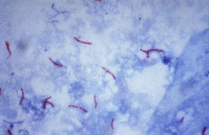 Acid-fast stain revealing Mycobacterium tuberculosis. Photo  courtesy of Dr. George P. Kubica and CDC