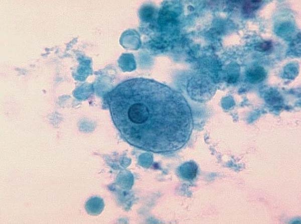 Entamoeba histolytica.