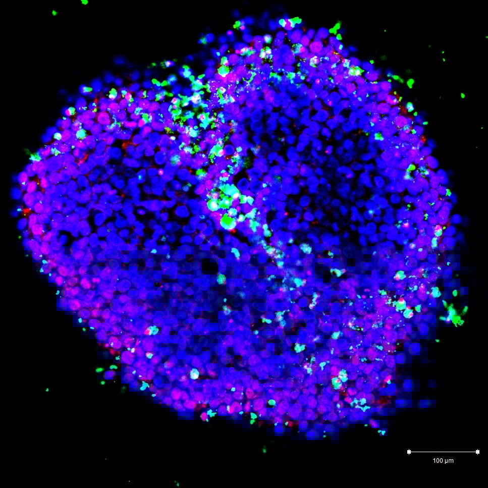 3-D tumor spheroid grown from MCF7 breast cancer cells