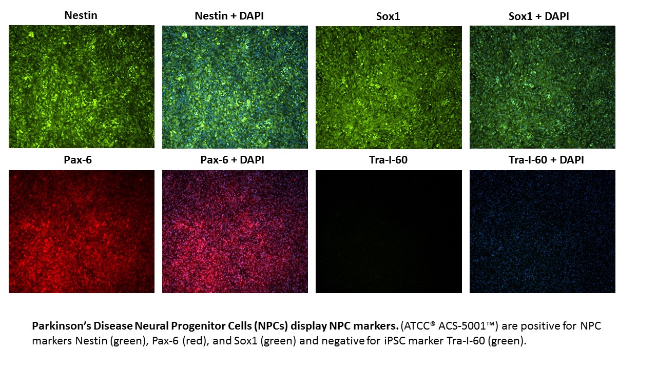 Parkinsons NPC Marker Expression