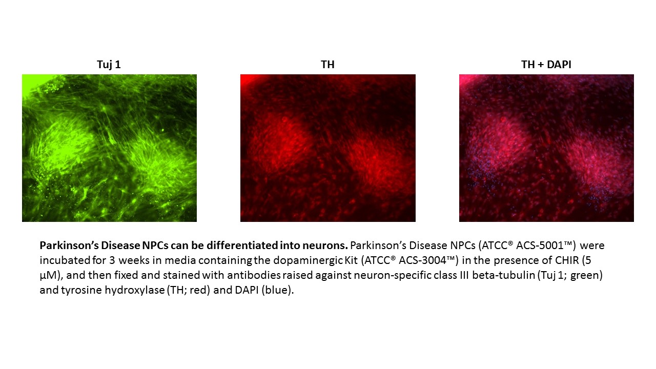 Parkinsons NPC Neuron Expression